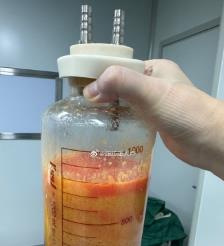 北票水动力吸脂手术要做多久？